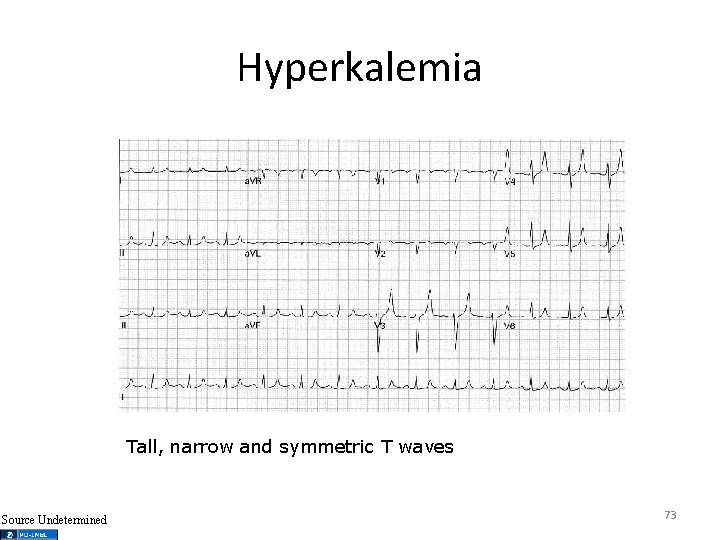 Hyperkalemia Tall, narrow and symmetric T waves Source Undetermined 73 