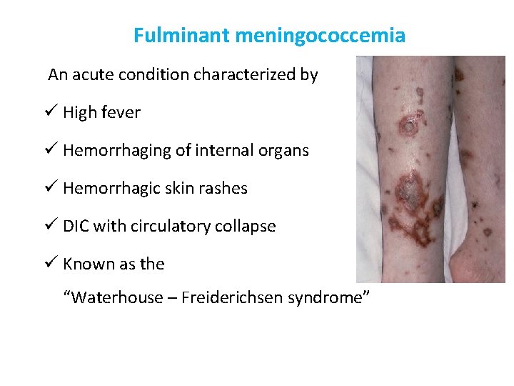 Fulminant meningococcemia An acute condition characterized by ü High fever ü Hemorrhaging of internal