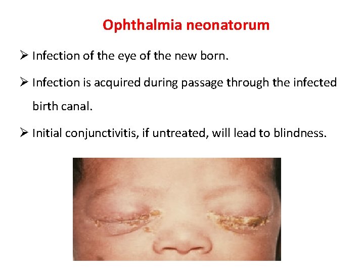 Ophthalmia neonatorum Ø Infection of the eye of the new born. Ø Infection is