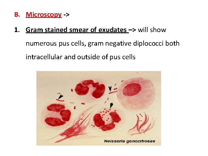 B. Microscopy -> 1. Gram stained smear of exudates –> will show numerous pus