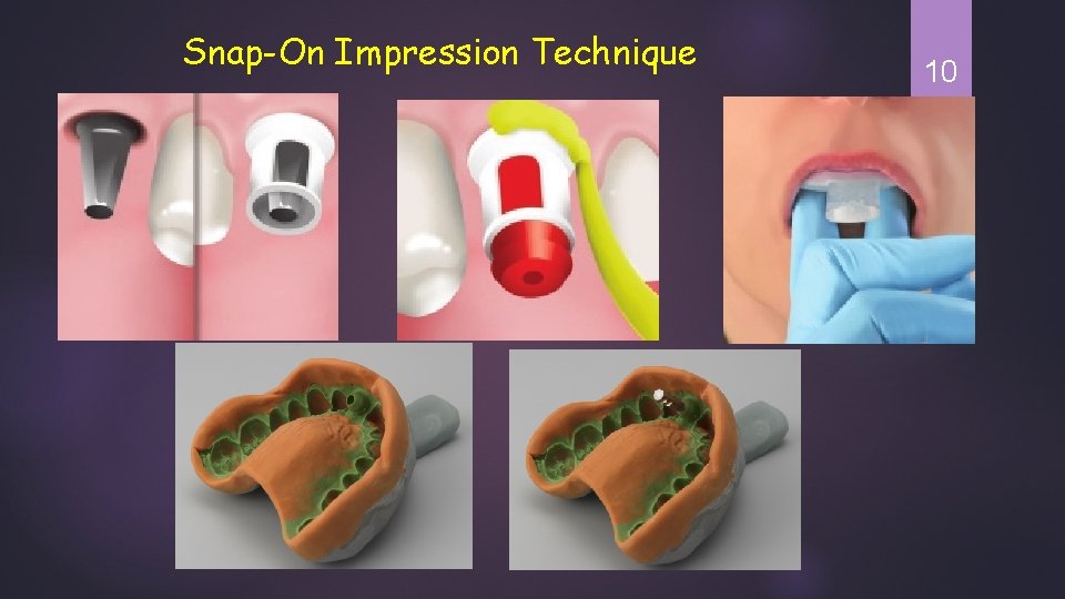 1 Impression Techniques of Dental implants Dr Sabreen