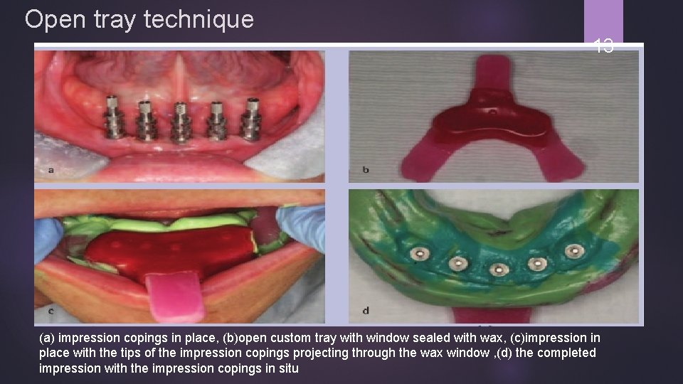 Open tray technique 13 (a) impression copings in place, (b)open custom tray with window