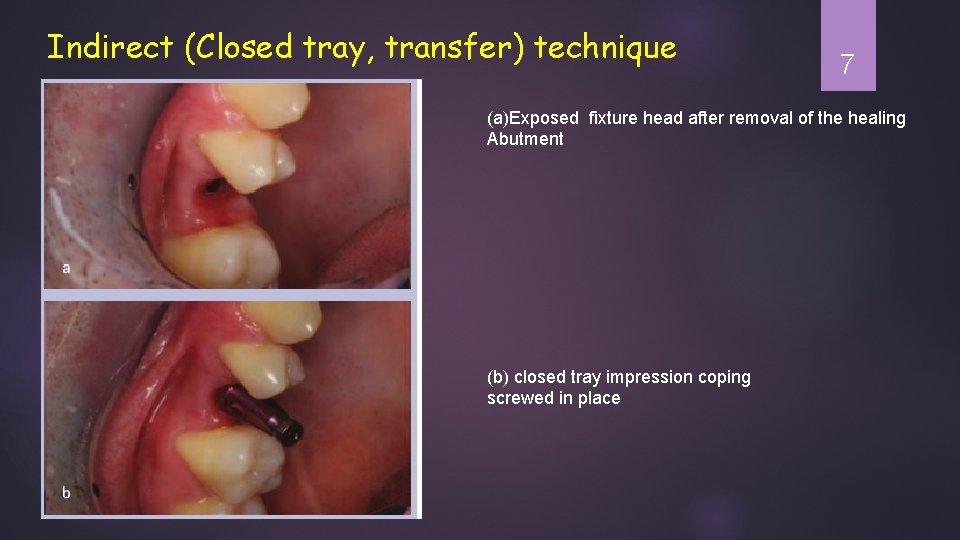 Indirect (Closed tray, transfer) technique 7 (a)Exposed fixture head after removal of the healing