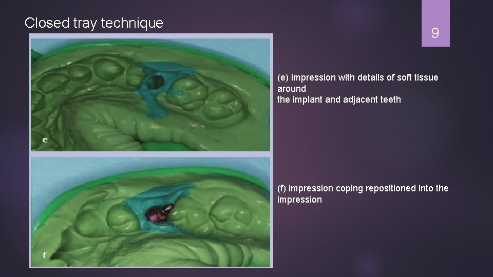 Closed tray technique 9 (e) impression with details of soft tissue around the implant