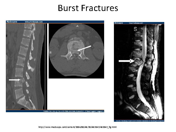 Burst Fractures http: //www. medscape. com/content/2004/00/48/20/482043_fig. html 