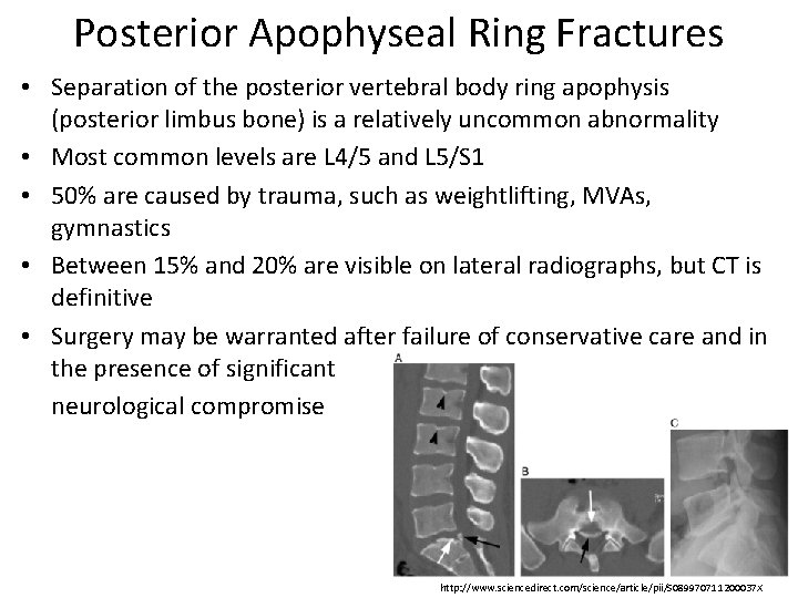 Posterior Apophyseal Ring Fractures • Separation of the posterior vertebral body ring apophysis (posterior