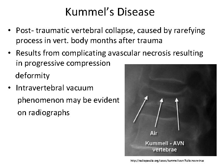 Kummel’s Disease • Post- traumatic vertebral collapse, caused by rarefying process in vert. body