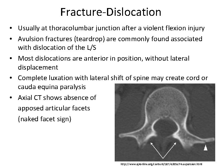 Fracture-Dislocation • Usually at thoracolumbar junction after a violent flexion injury • Avulsion fractures