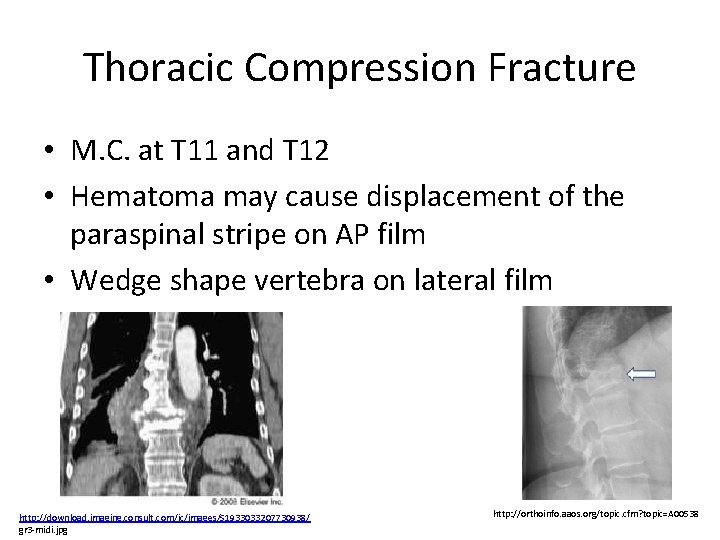 Thoracic Compression Fracture • M. C. at T 11 and T 12 • Hematoma