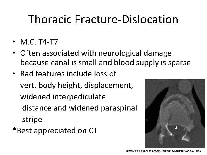 Thoracic Fracture-Dislocation • M. C. T 4 -T 7 • Often associated with neurological