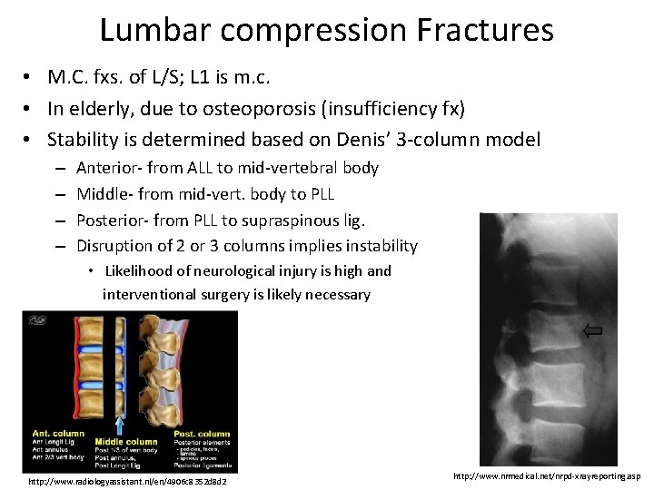 Lumbar compression Fractures • M. C. fxs. of L/S; L 1 is m. c.