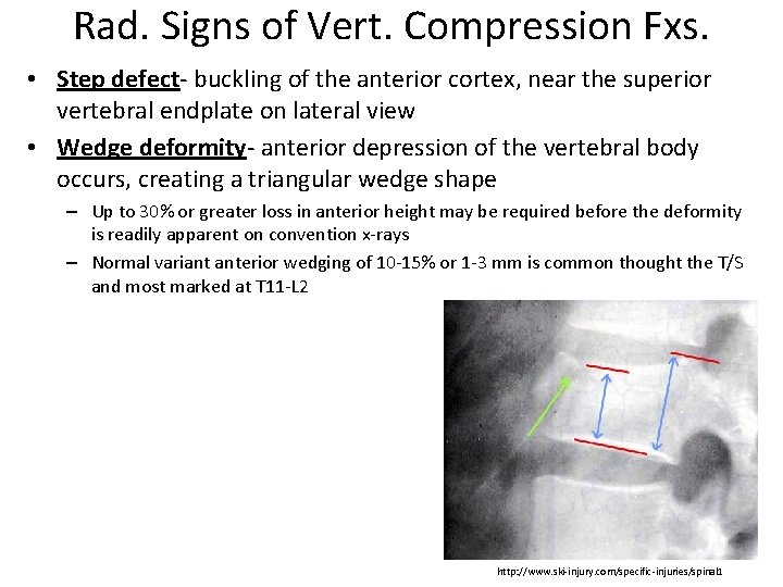 Rad. Signs of Vert. Compression Fxs. • Step defect- buckling of the anterior cortex,