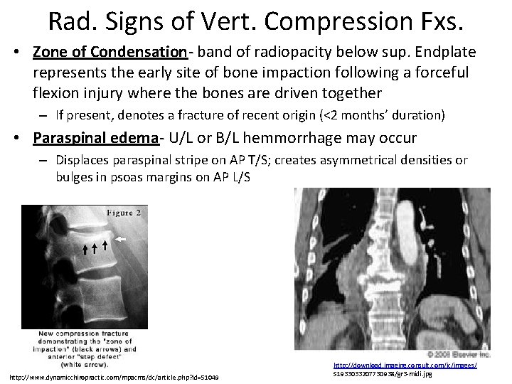 Rad. Signs of Vert. Compression Fxs. • Zone of Condensation- band of radiopacity below