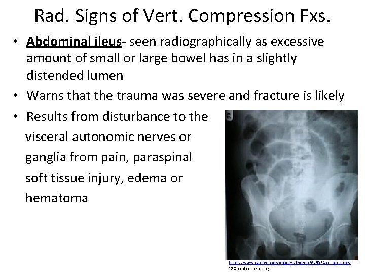 Rad. Signs of Vert. Compression Fxs. • Abdominal ileus- seen radiographically as excessive amount