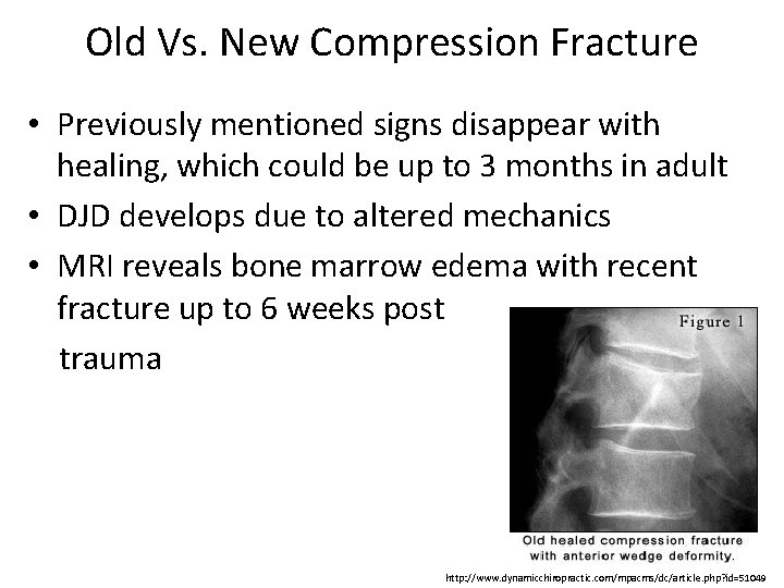 Old Vs. New Compression Fracture • Previously mentioned signs disappear with healing, which could