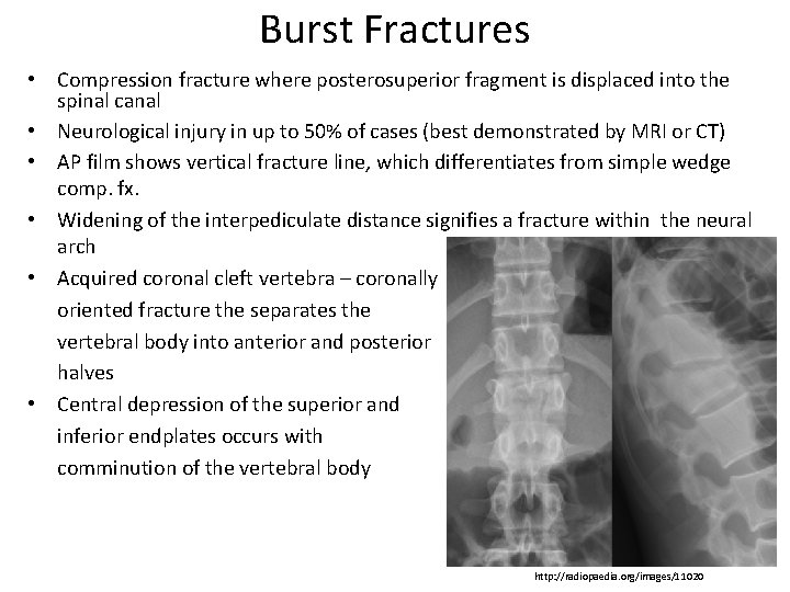 Burst Fractures • Compression fracture where posterosuperior fragment is displaced into the spinal canal