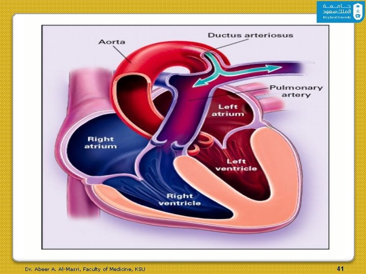 Patent Ductus Arteriosus with Resultant Left-to-Right Shunting Dr. Abeer A. Al-Masri, Faculty of Medicine, Patent Ductus Arteriosus with Resultant Left-to-Right Shunting Dr. Abeer A. Al-Masri, Faculty of Medicine,