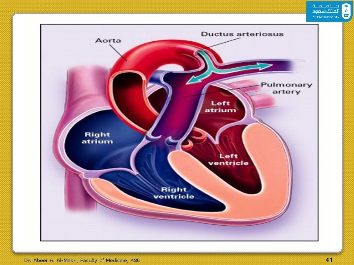 Patent Ductus Arteriosus with Resultant Left-to-Right Shunting Dr. Abeer A. Al-Masri, Faculty of Medicine,