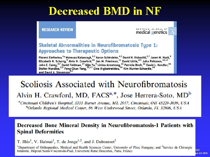 Decreased BMD in NF 