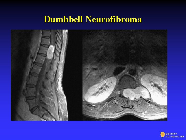 Dumbbell Neurofibroma 