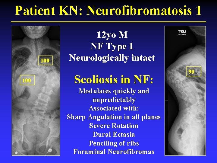 Patient KN: Neurofibromatosis 1 100 12 yo M NF Type 1 Neurologically intact Scoliosis