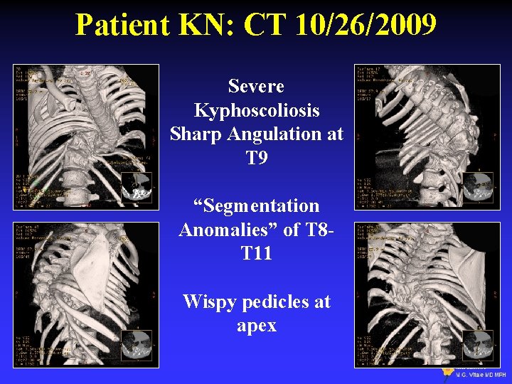 Patient KN: CT 10/26/2009 Severe Kyphoscoliosis Sharp Angulation at T 9 “Segmentation Anomalies” of