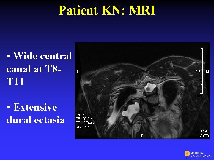 Patient KN: MRI • Wide central canal at T 8 T 11 • Extensive