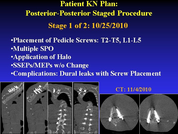 Patient KN Plan: Posterior-Posterior Staged Procedure Stage 1 of 2: 10/25/2010 • Placement of