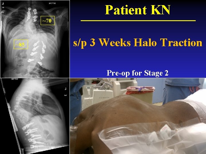 Patient KN ~70 ~85 s/p 3 Weeks Halo Traction Pre-op for Stage 2 