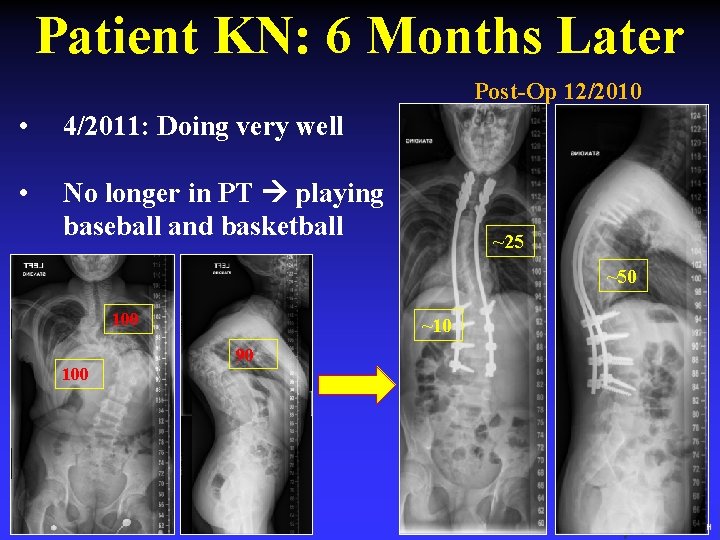 Patient KN: 6 Months Later Post-Op 12/2010 • 4/2011: Doing very well • No