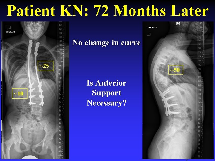 Patient KN: 72 Months Later No change in curve ~25 ~10 ~50 Is Anterior