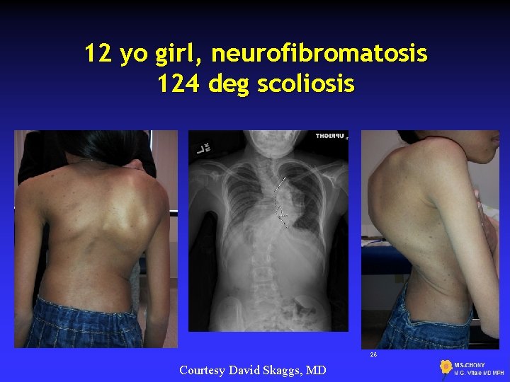 12 yo girl, neurofibromatosis 124 deg scoliosis 26 Courtesy David Skaggs, MD 