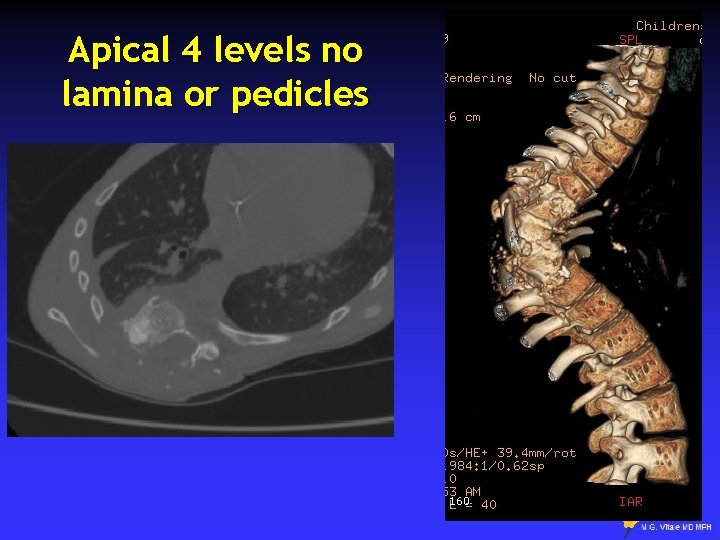 Apical 4 levels no lamina or pedicles 27 