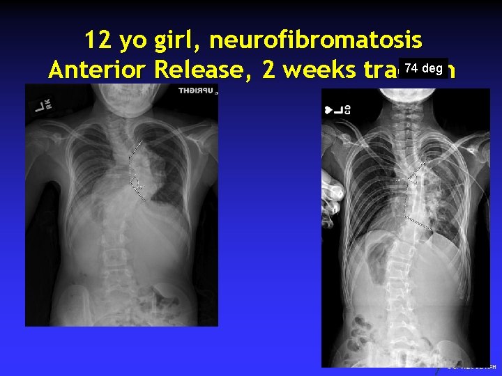 12 yo girl, neurofibromatosis 74 deg Anterior Release, 2 weeks traction 28 