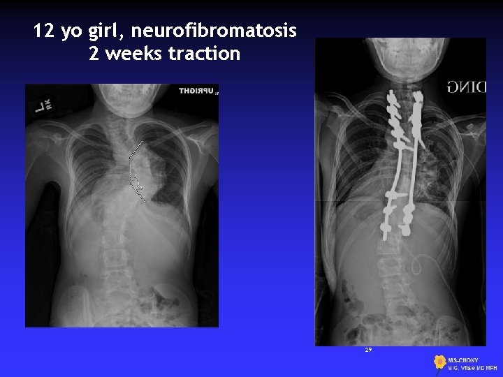 12 yo girl, neurofibromatosis 2 weeks traction 74 deg 29 