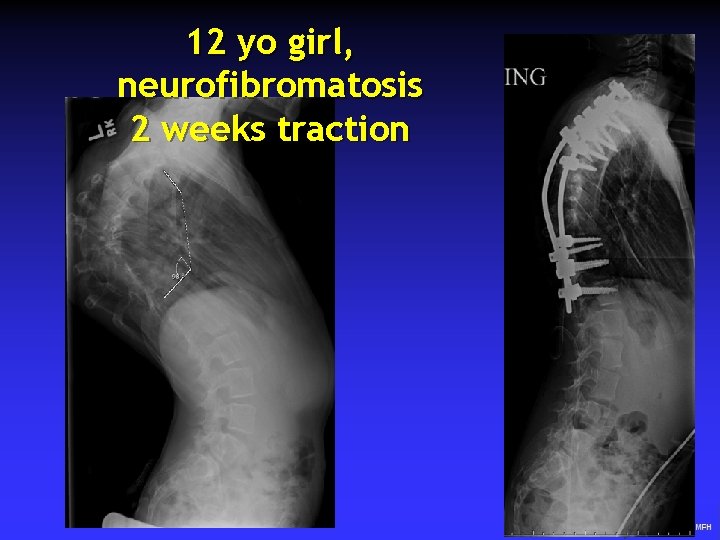 12 yo girl, neurofibromatosis 2 weeks traction 30 