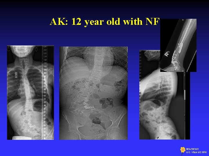 AK: 12 year old with NF 