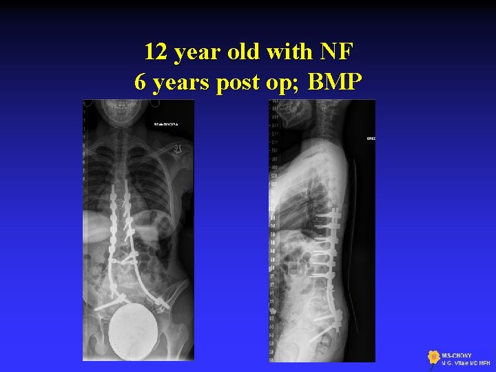 12 year old with NF 6 years post op; BMP 