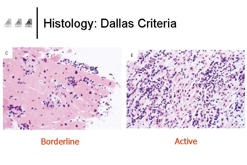 Histology: Dallas Criteria Borderline Active 