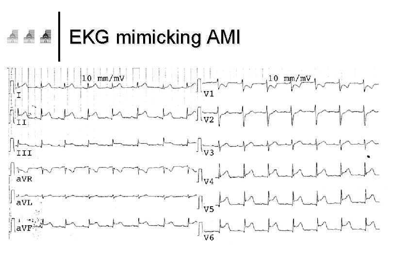 EKG mimicking AMI 