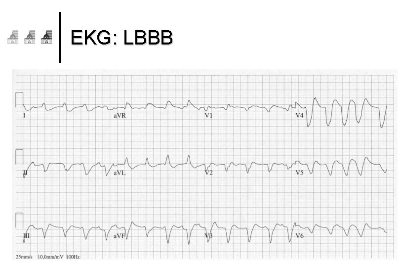 EKG: LBBB 