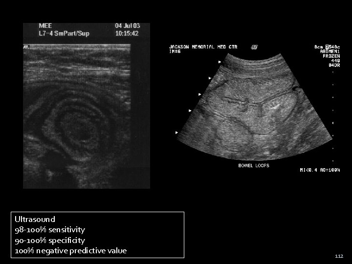 Ultrasound 98 -100% sensitivity 90 -100% specificity 100% negative predictive value 112 