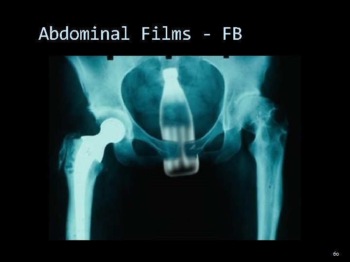 Abdominal Films - FB 60 