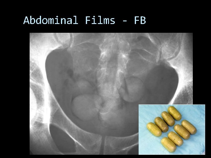 Abdominal Films - FB 61 