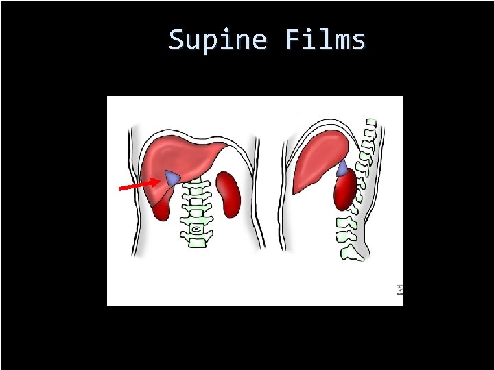 Supine Films 70 