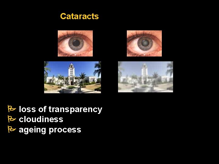 Cataracts loss of transparency cloudiness ageing process Cataracts loss of transparency cloudiness ageing process