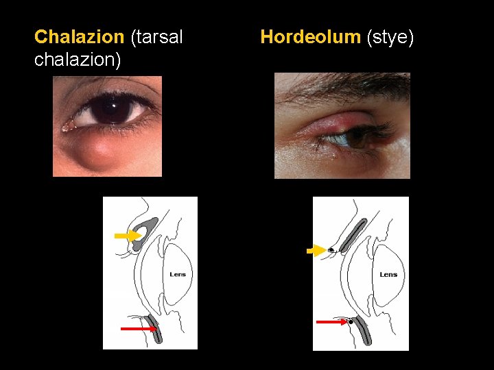 Chalazion (tarsal chalazion) Hordeolum (stye) Chalazion (tarsal chalazion) Hordeolum (stye)