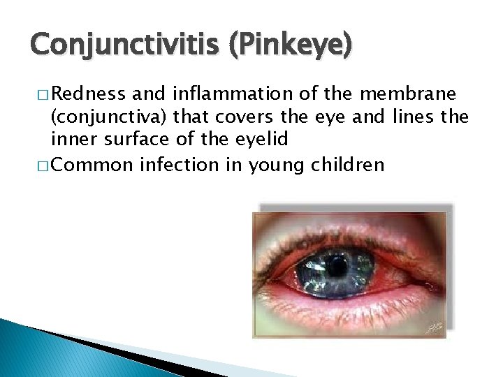 Conjunctivitis (Pinkeye) � Redness and inflammation of the membrane (conjunctiva) that covers the eye