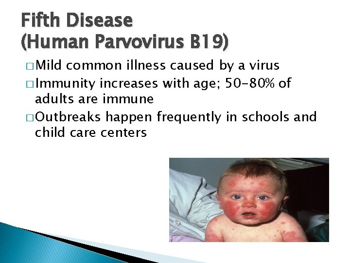 Fifth Disease (Human Parvovirus B 19) � Mild common illness caused by a virus