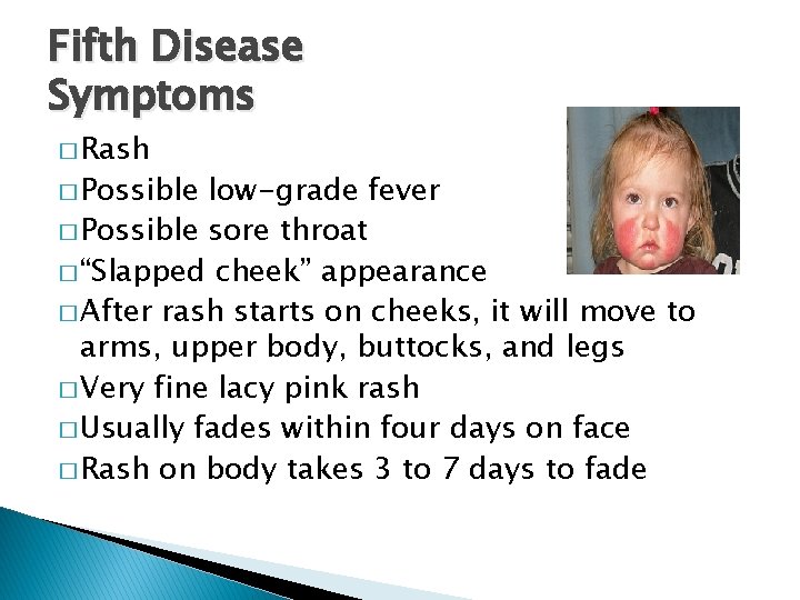 Fifth Disease Symptoms � Rash � Possible low-grade fever � Possible sore throat �